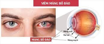 VIÊM MÀNG BỒ ĐÀO: PHÂN LOẠI VÀ NGUYÊN NHÂN