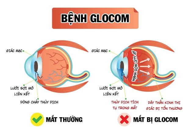Bệnh Glôcôm –Ai nguy cơ cao mắc?