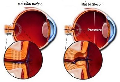 BỆNH GLÔCÔM - LÀM SAO ĐỂ PHÁT HIỆN?