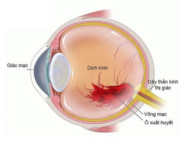 MÀNG TRƯỚC VÕNG MẠC - ĐIỀU TRỊ VÀ THEO DÕI