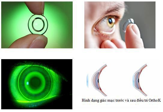 Ortho K - Phương pháp điều trị tật cận thị không phẫu thuật