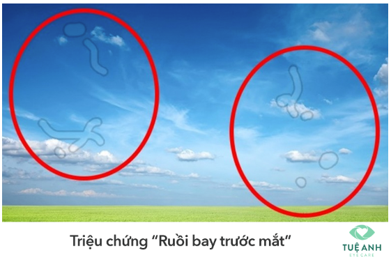 BONG VÕNG MẠC - NGUYÊN NHÂN VÀ CÁCH PHÒNG NGỪA P1