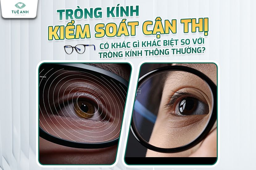 Tròng kính kiểm soát cận thị – Giải pháp tiên tiến cho trẻ em và thanh thiếu niên