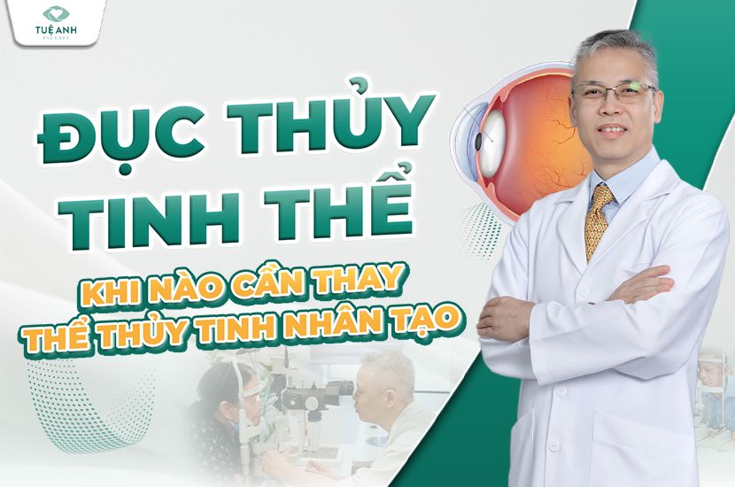 Đục thủy tinh thể: Khi nào cần thay thủy tinh thể nhân tạo