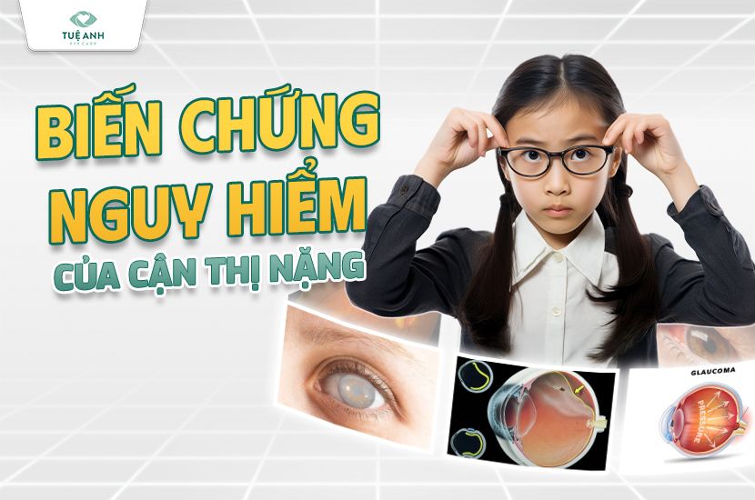 Biến chứng nguy hiểm của cận thị nặng mà ba mẹ không nên bỏ qua 