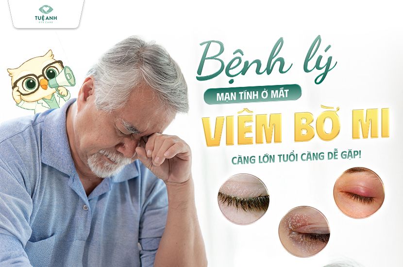 Viêm bờ mi là gì? Dấu hiệu, cách điều trị và phòng ngừa hiệu quả