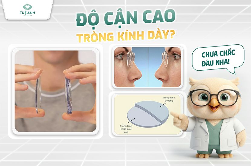 Độ cận cao - Tròng kính dày? Chưa chắc đâu! 