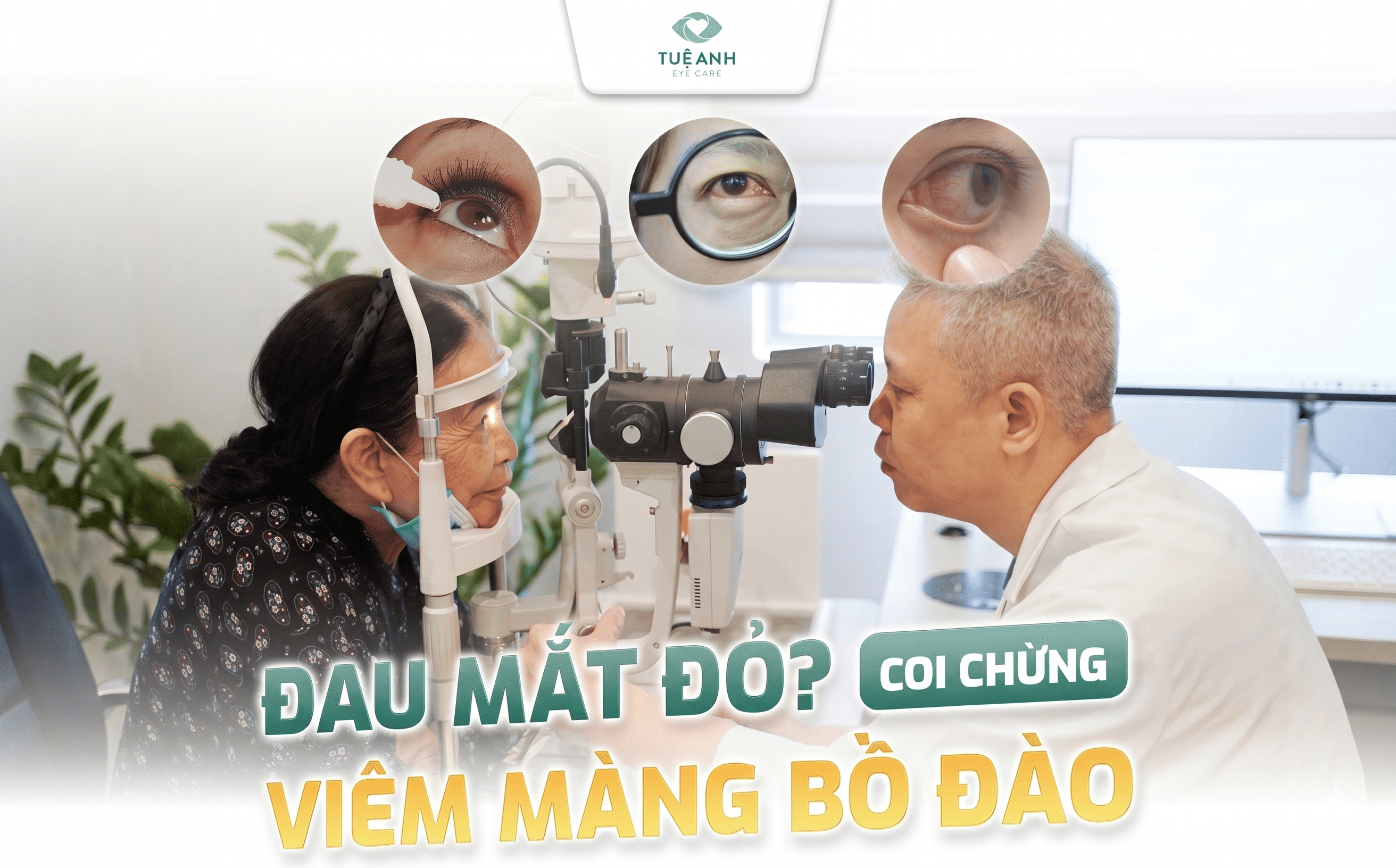 Viêm màng bồ đào – bệnh lý có thể gây giảm thị lực vĩnh viễn nếu điều trị muộn