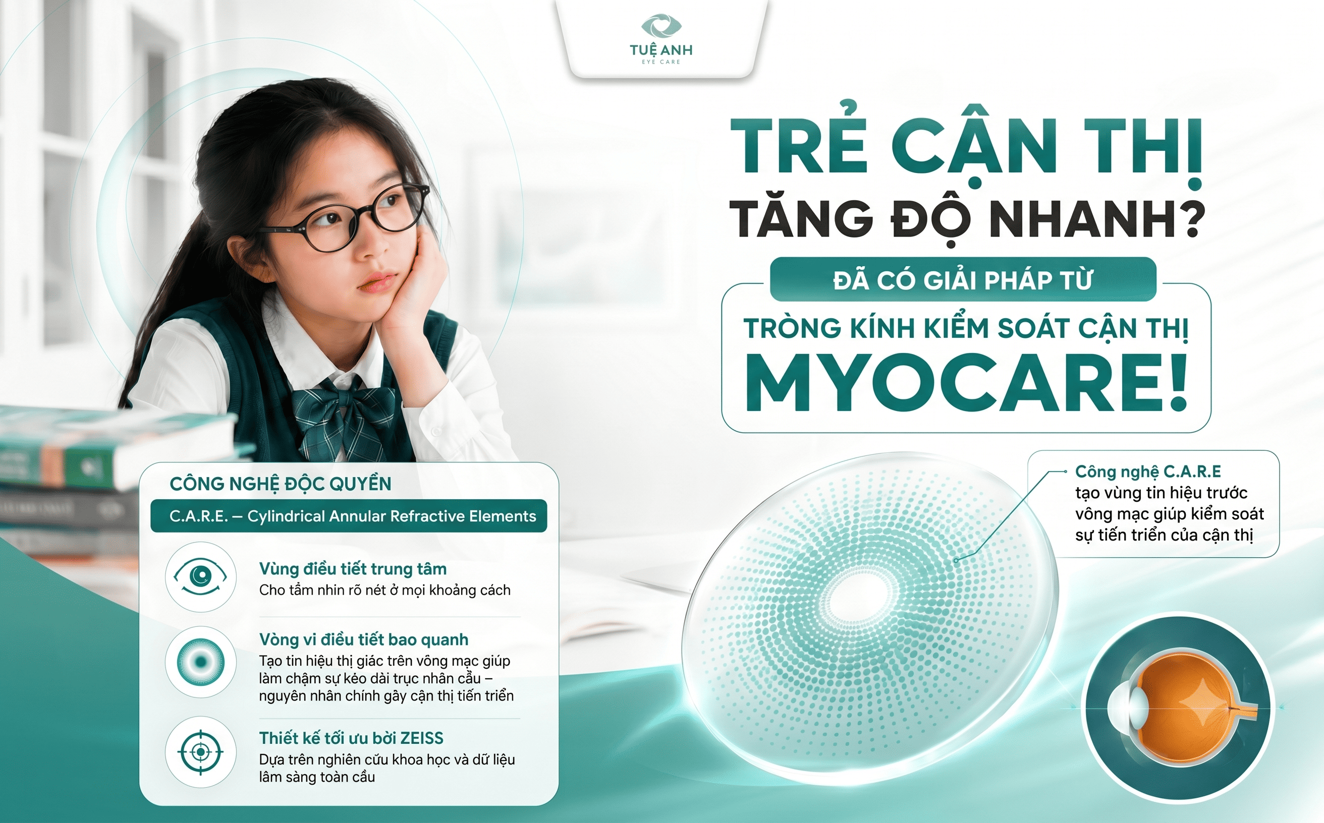 Trẻ cận thị tăng độ nhanh? Giải pháp vàng từ tròng kính kiểm soát cận thị Myocare