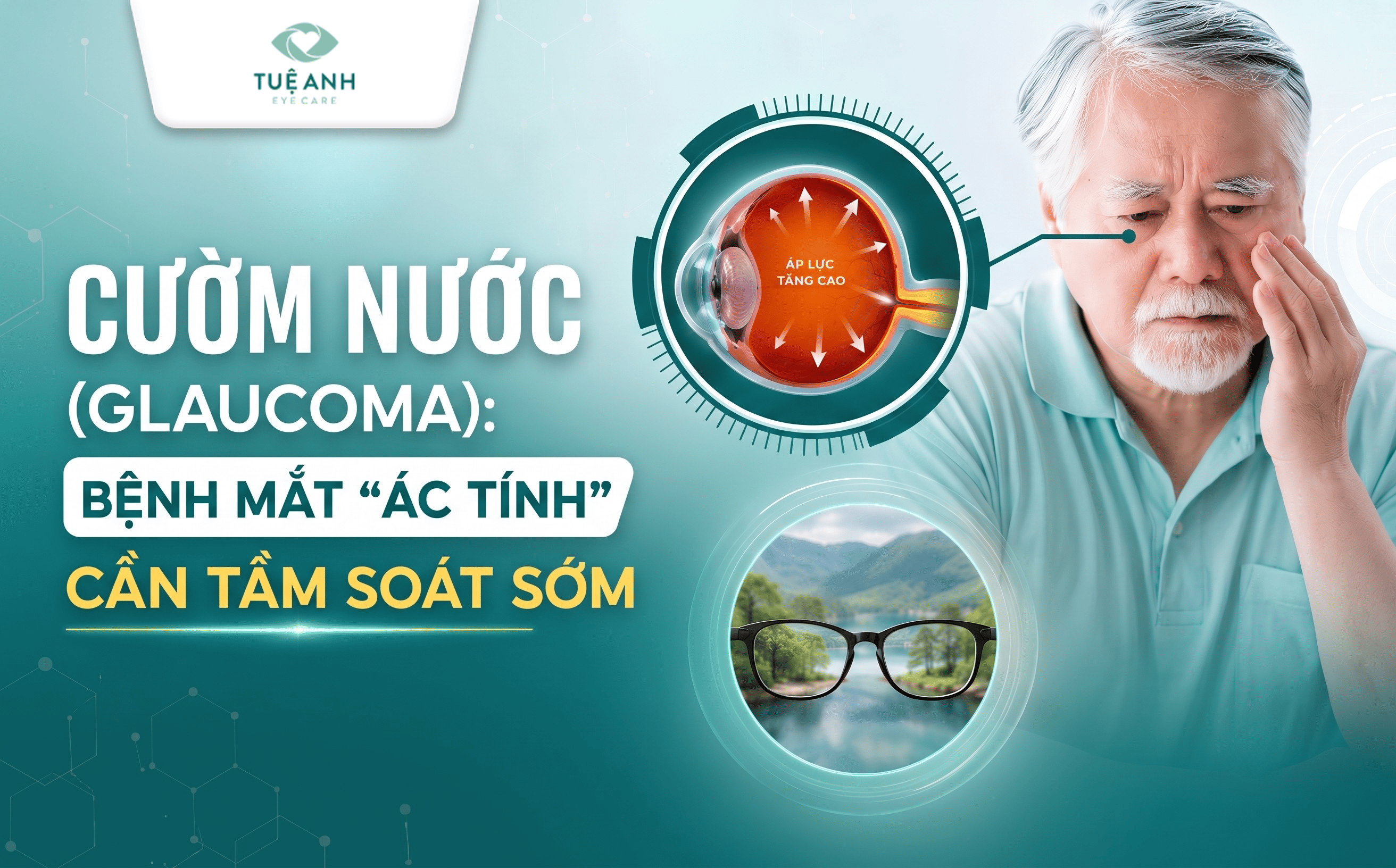 Cườm nước (Glaucoma): Bệnh lý gây mất thị lực không hồi phục cần tầm soát sớm
