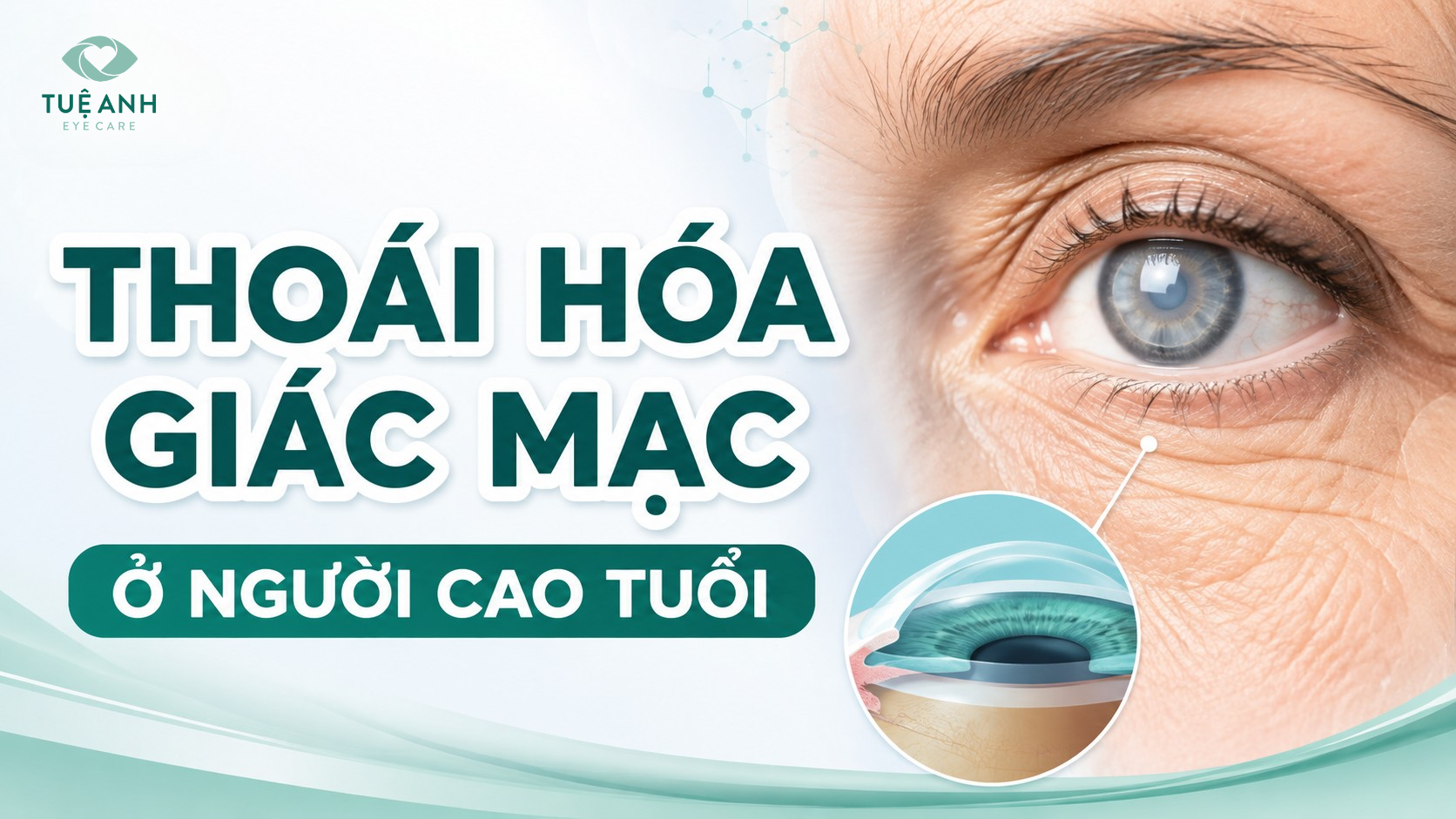 Thoái hóa giác mạc ở người cao tuổi: Dấu hiệu và cách điều trị