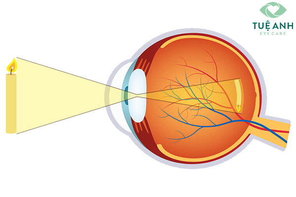 Hình ảnh của vật trên mắt cận thị.