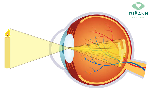 Hình ảnh của vật trên mắt loạn thị. 