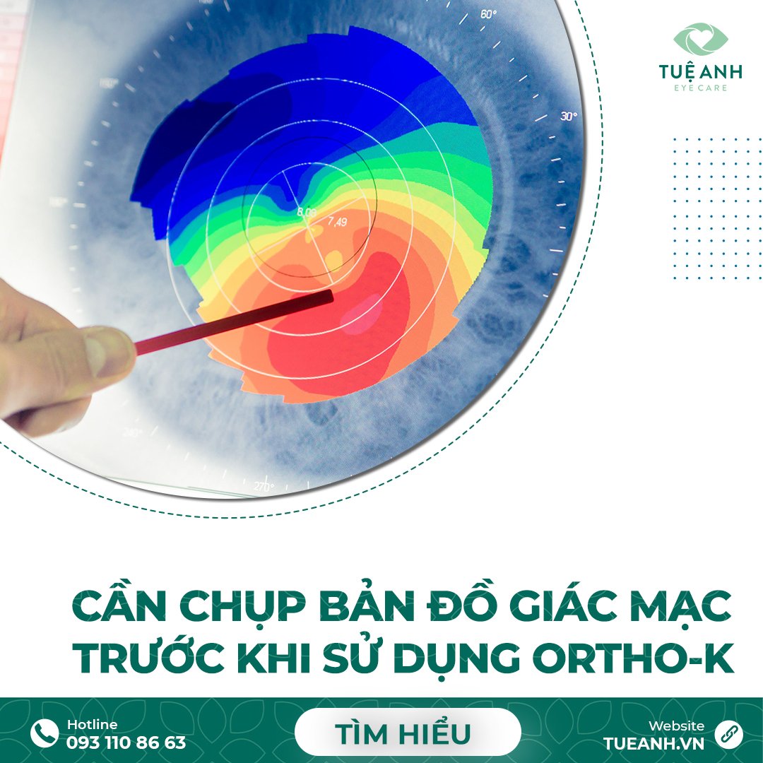 Bác sĩ sẽ khám và chẩn đoán khung mắt của bệnh nhân để đưa ra khung kính Ortho K phù hợp