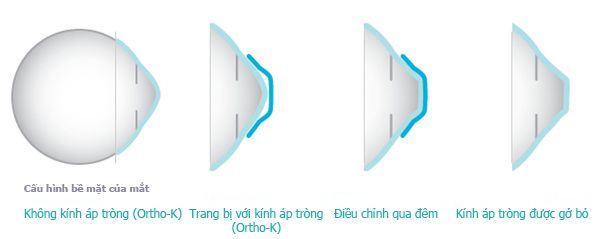 Trong khi ngủ, các tròng kính nhẹ nhàng thay đổi hình dáng giác mạc để người sử dụng nhìn rõ ràng vào ngày hôm sau